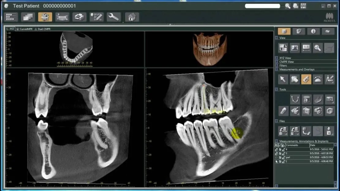 understanding the advantages of 3d dental imaging
